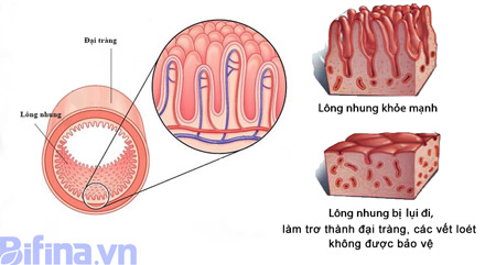 Công thức đột phá mới thoát khỏi viêm đại tràng dai dẳng.