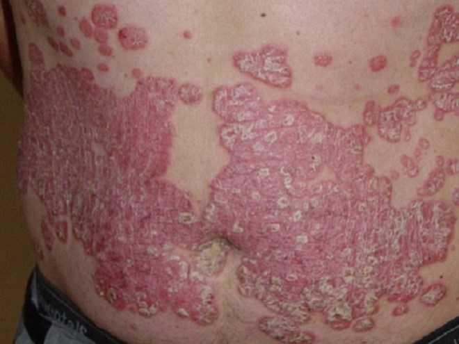 da bị tổn thương do tác dụng phụ của corticoid