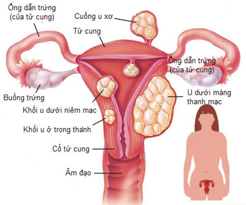 bệnh ung xơ tử cung
