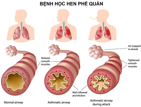 mô tả phế quản của người bình thường và người bị hen