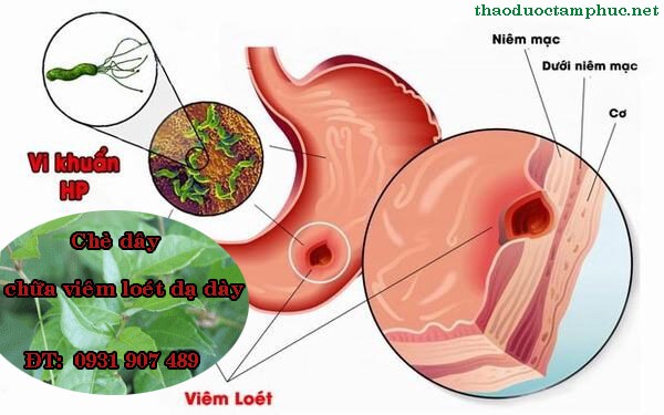chè dây chữa loét dạ dày